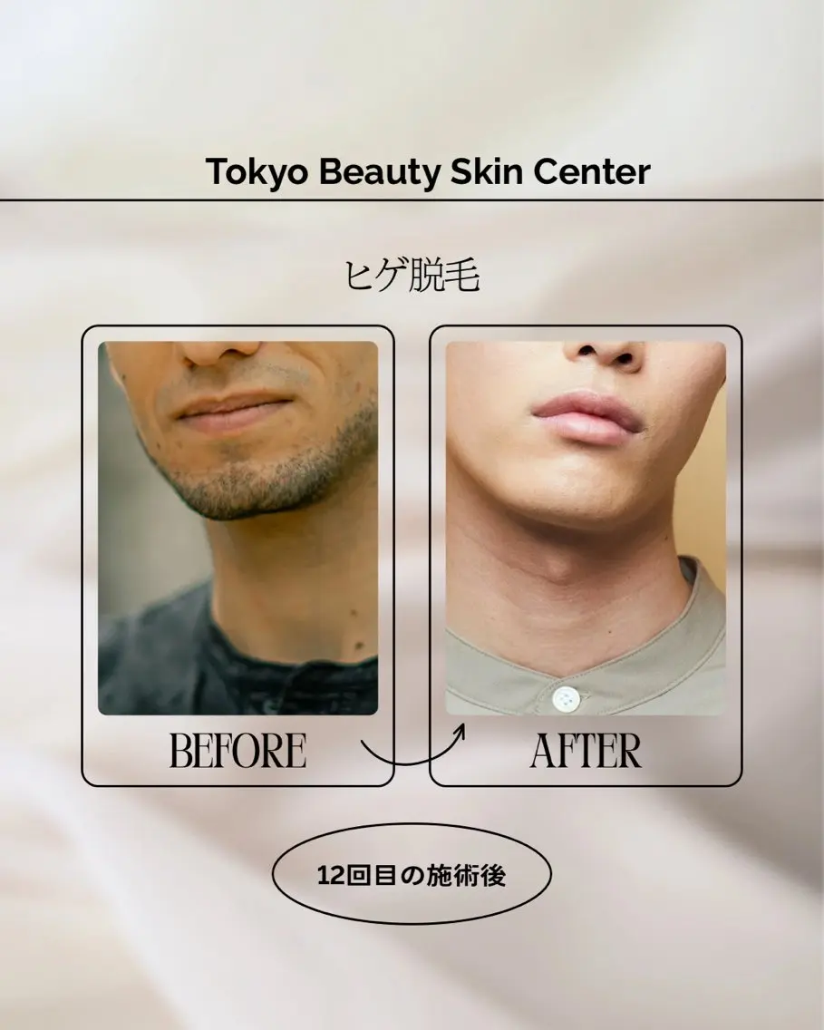 【メンズ脱毛】🥸ヒゲ全体(頬から首全体)痛みが少なく効果◎の写真
