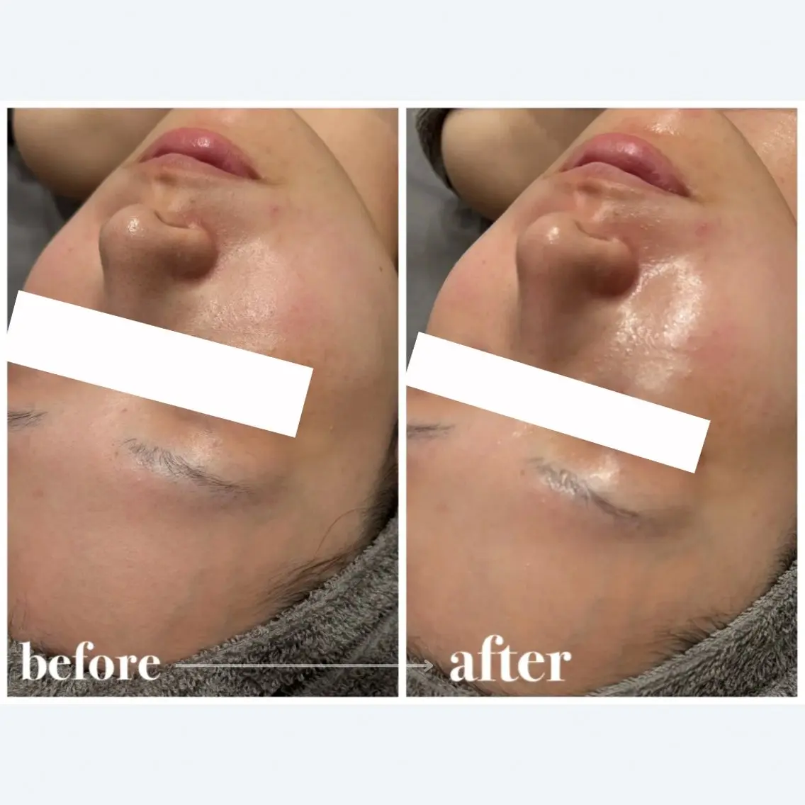 【エステ版ダーマペン】リジュラン+悩み別美容液導入🪄︎︎毛穴洗浄付きの写真