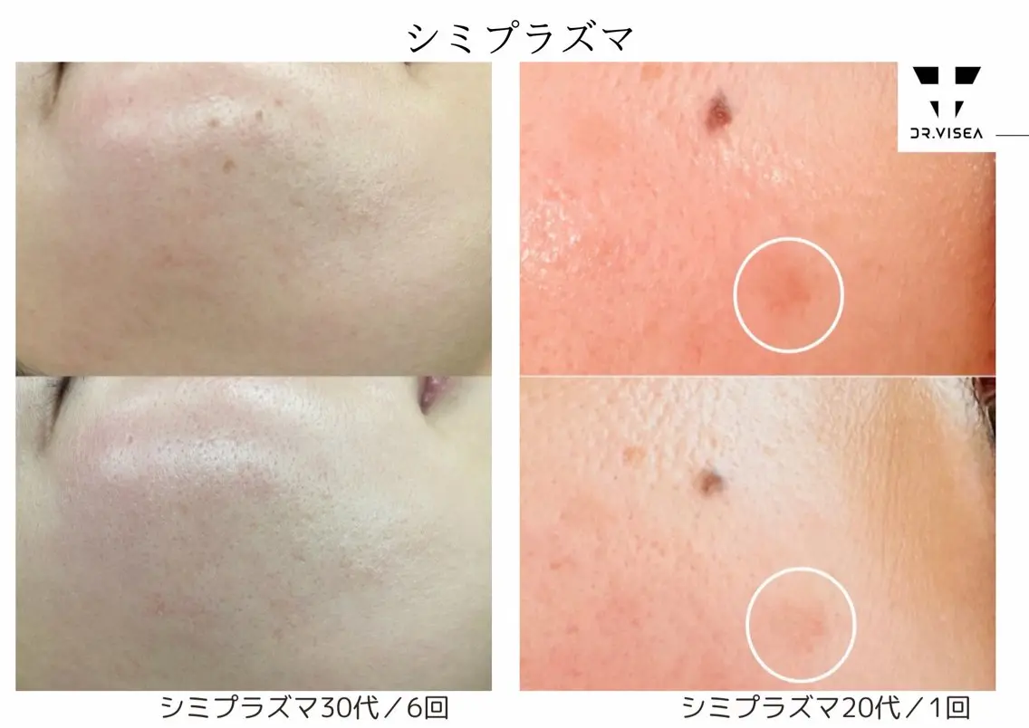 シミ集中ケアメニュー【10分】＋お顔の殺菌の写真
