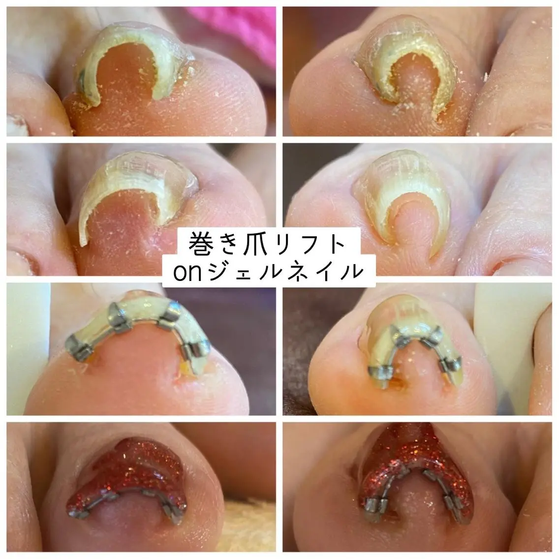 ネイル ♢ME2ROOM♢ #巻き爪#リラクのネイルデザイン