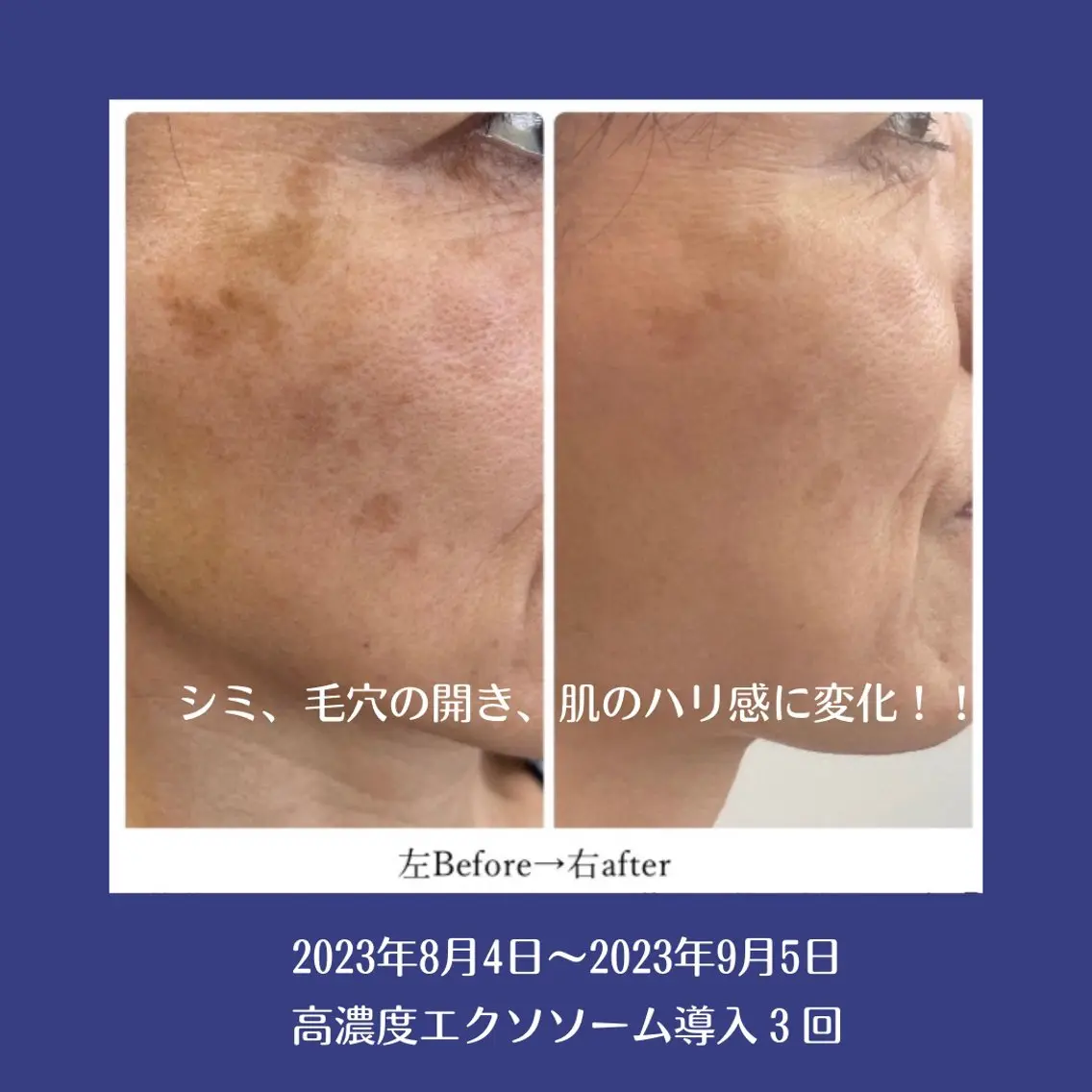 【新規限定】肌コンディションを底上げする高濃度プレミアム美容液導入フェイシャルの写真