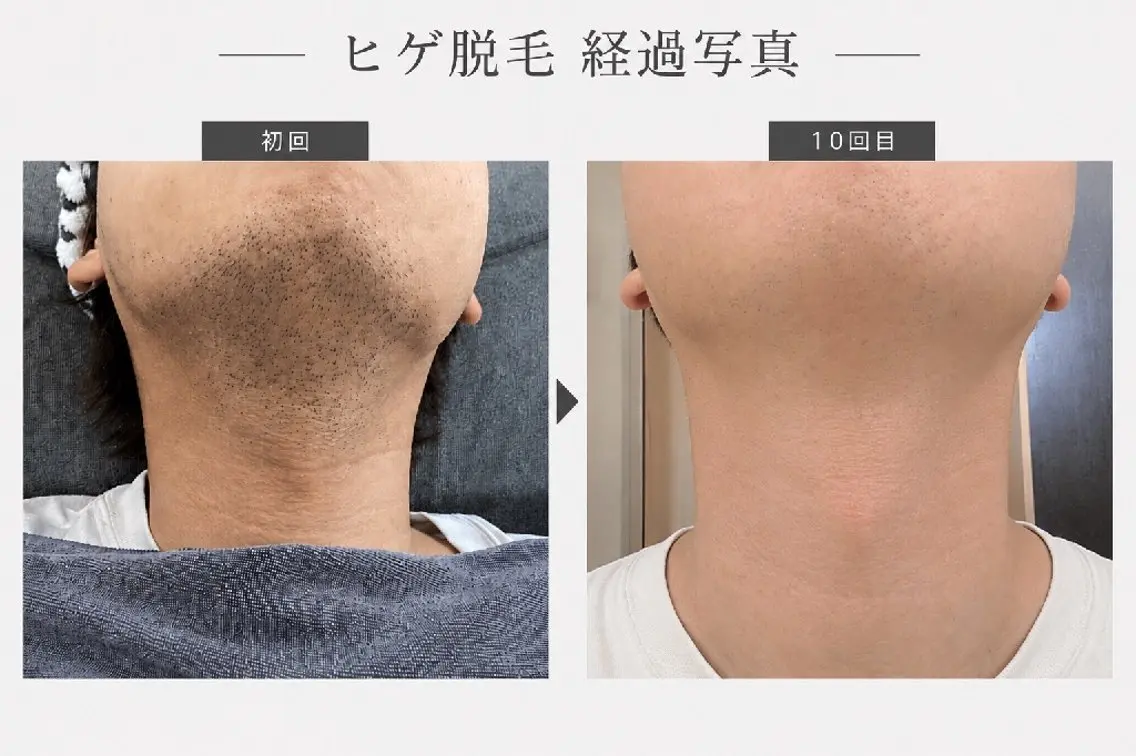 【メンズ】ヒゲ脱毛の写真