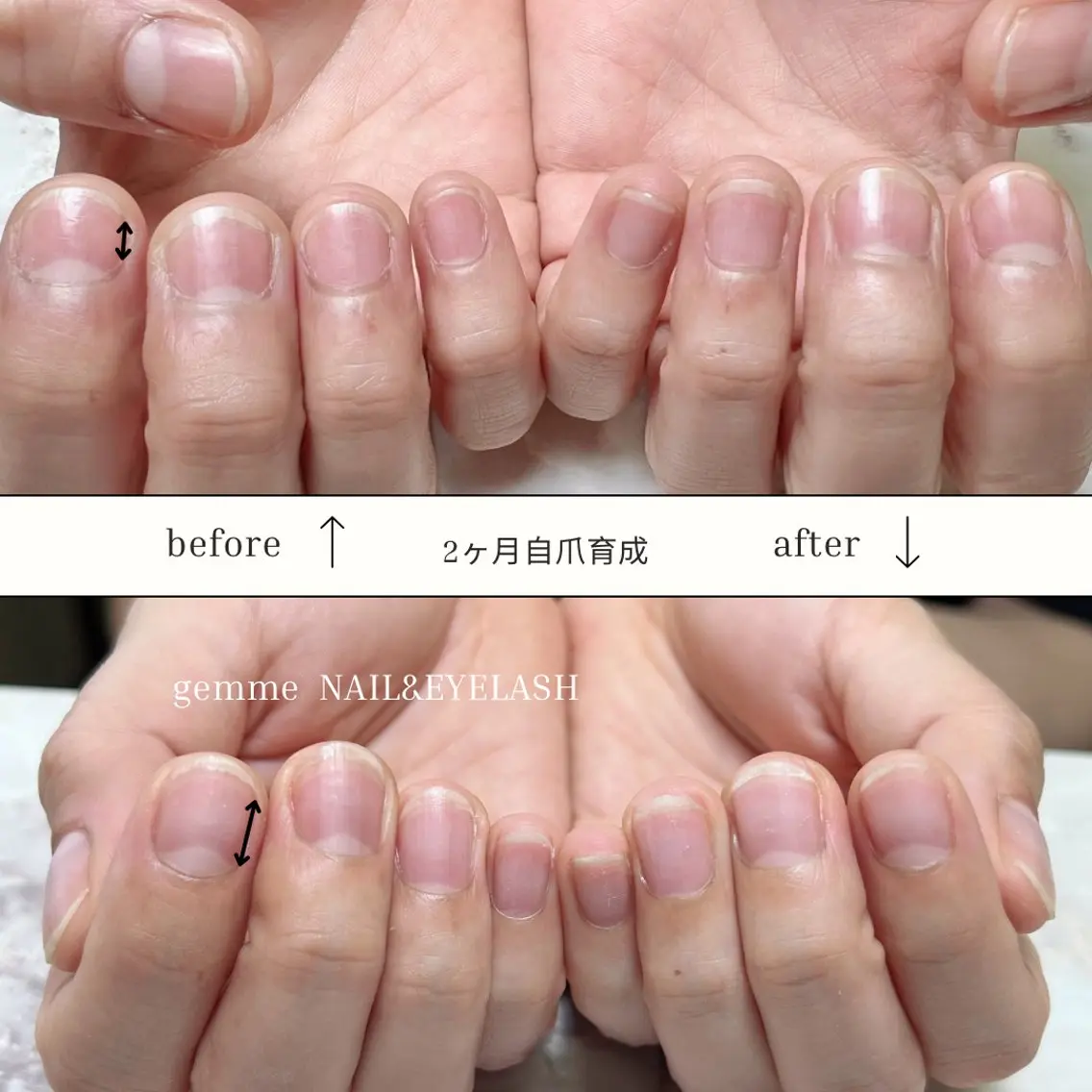 特許取得の自爪育成ˊ˗5回コースの写真