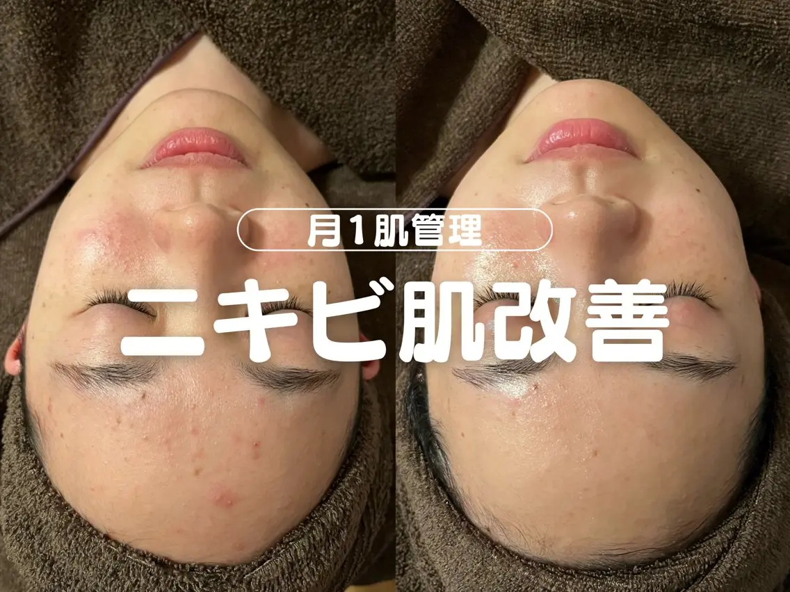 【人気No.1🥇】オーダーメイド肌質改善🌿【肌タイプに合わせたオーダーメイド施術💎💎フルオプション込み価格】の写真