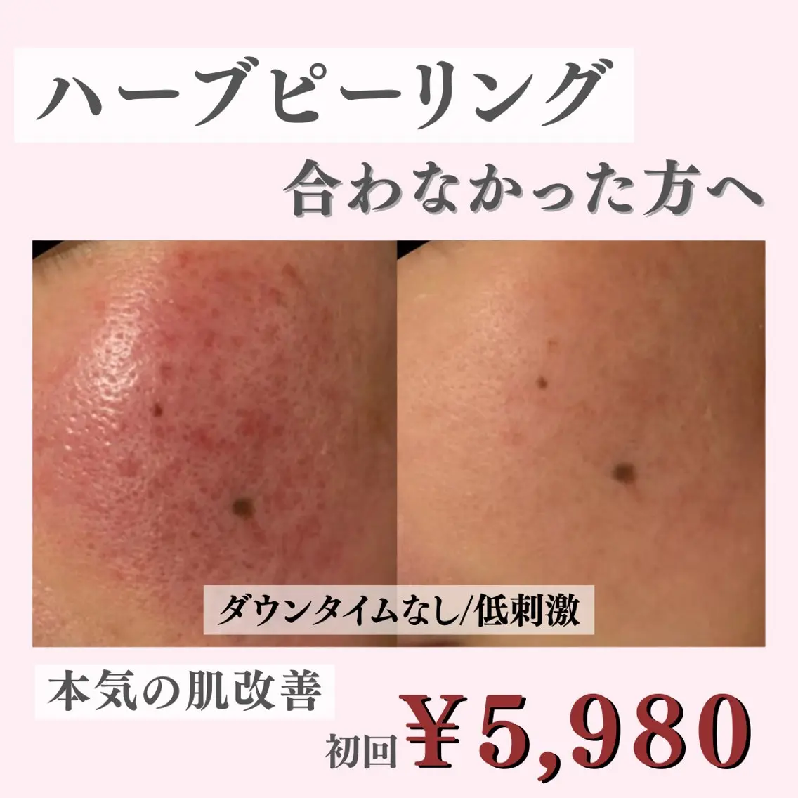 【人気No.1】脱・ハーブピーリング!!痛くないミネラルイオン艶肌✨の写真