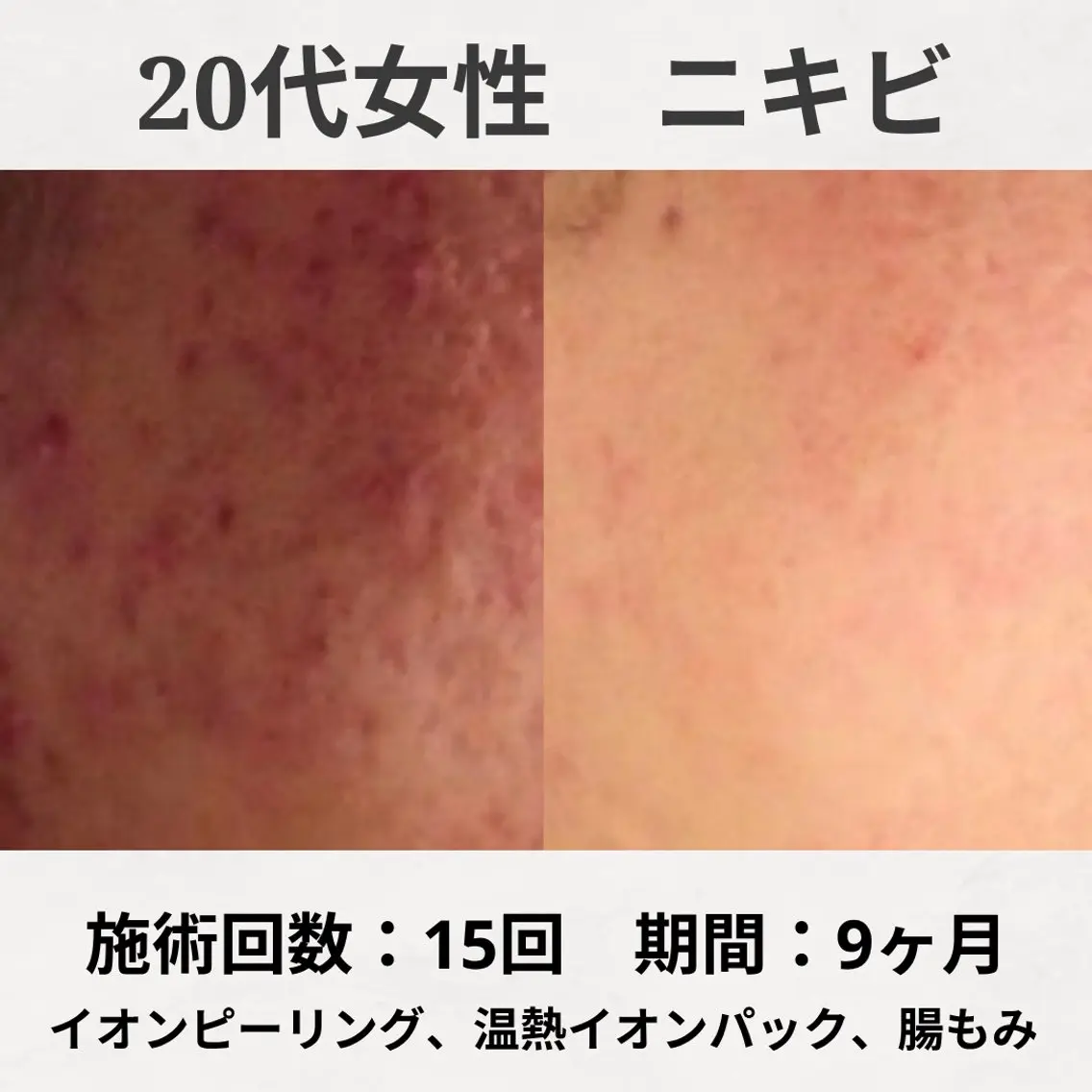 エステ リラク 繰り返すニキビ跡専門 根本改善のエステ・リラクイメージ