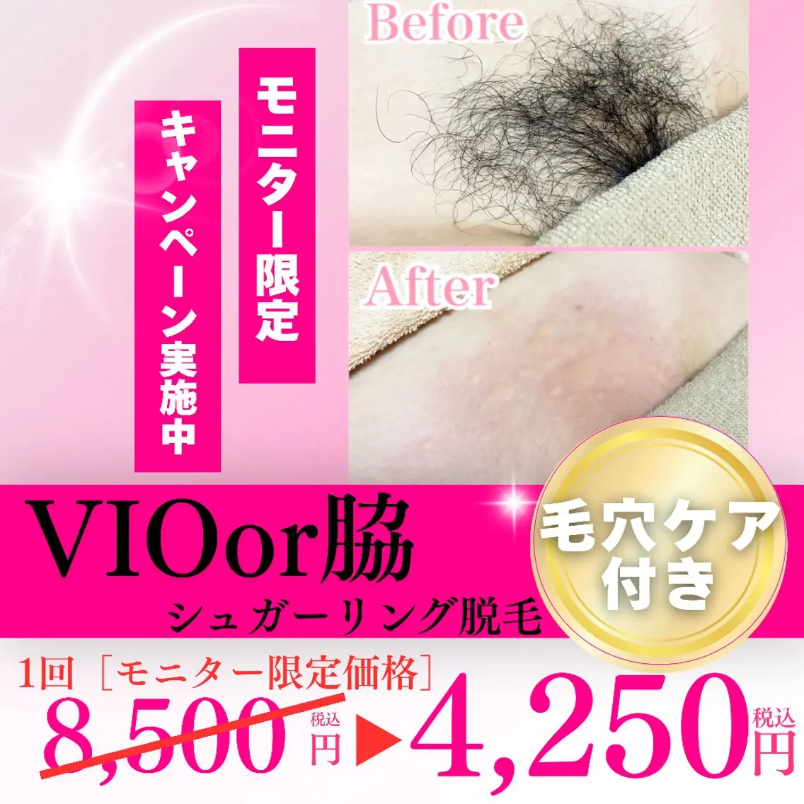 《VIOシュガーリング脱毛モニター募集》通常価格より『50%OFF』!!の写真