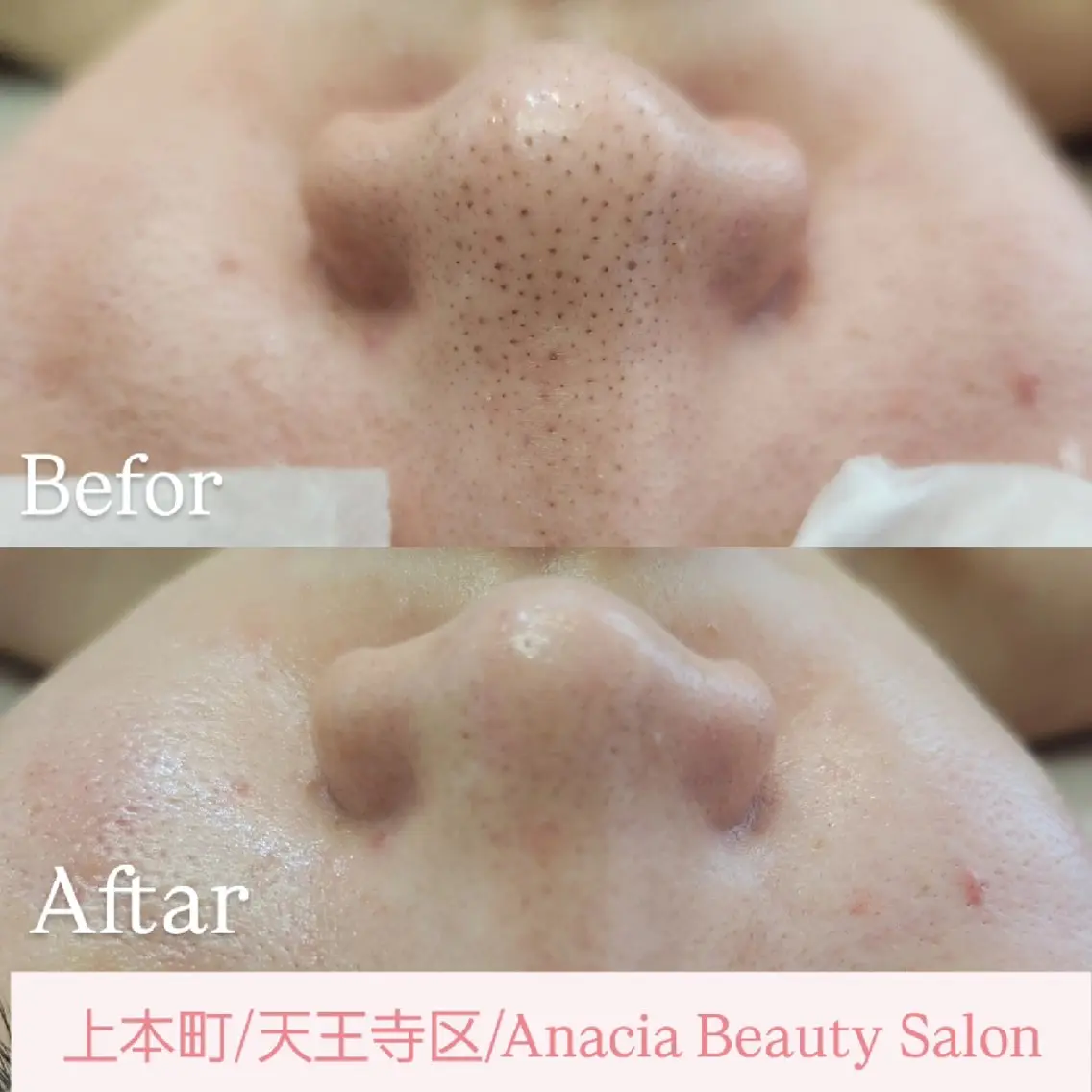 脱毛 美肌脱毛&毛穴専門 Anaciaのエステ・リラクイメージ