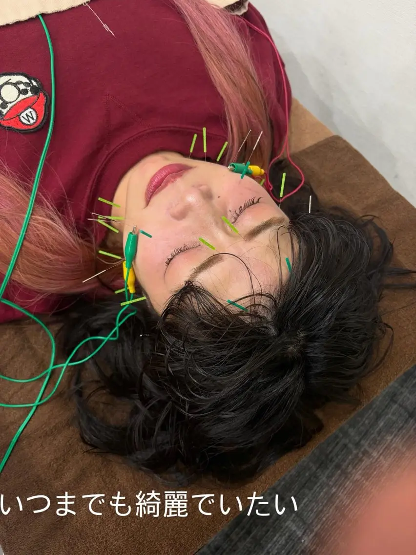 【初回限定】美容鍼2回セット💆‍♀️7,500円｜小顔×肌質改善の写真