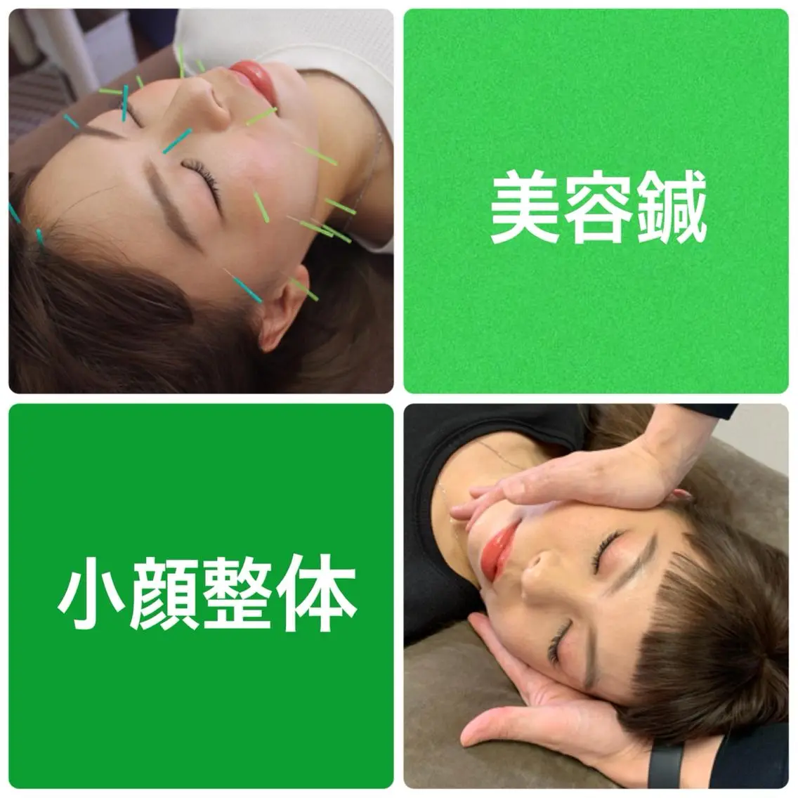 【 美容鍼 + 小顔整体 】(目元スッキリ、お顔のむくみスッキリ)カウンセリング付 70分 ¥9,000→¥4,800の写真