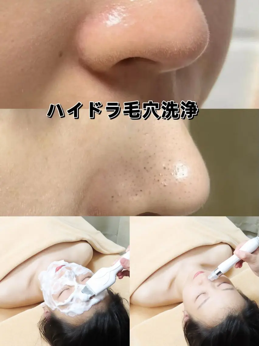 🉐SALE🉐毛穴黒ず🥚つるっんとたまご肌👍ハイドラ毛穴全顔+ヒアルロン酸導入+小顔+パック💚 60¥3990の写真
