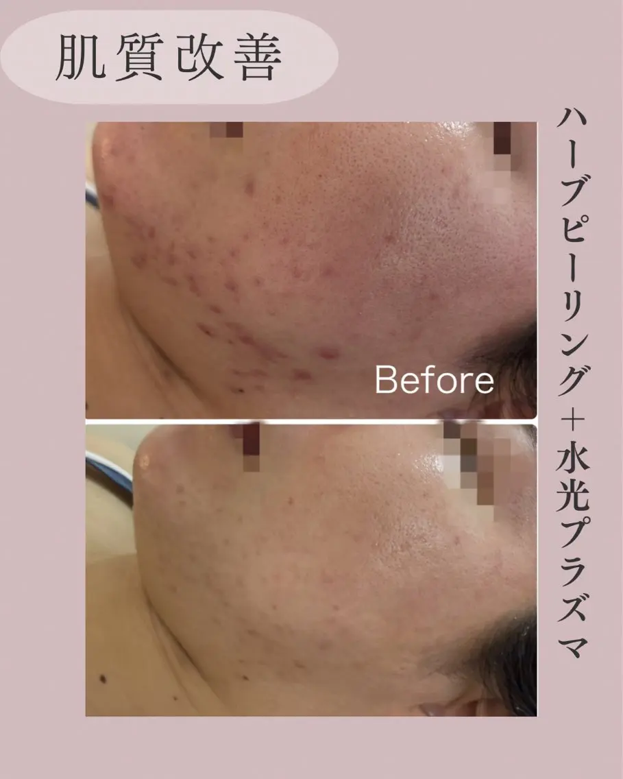 エステ 小顔＆肌質改善 NICORIのエステ・リラクイメージ