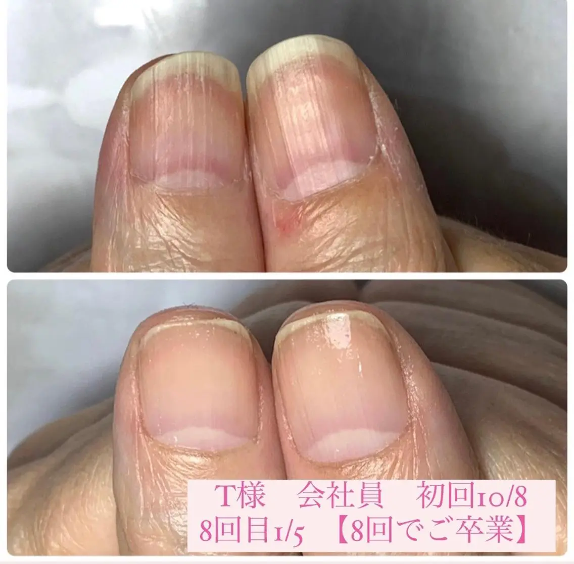 ネイル 自爪育成/深爪矯正 mikiのネイルデザイン