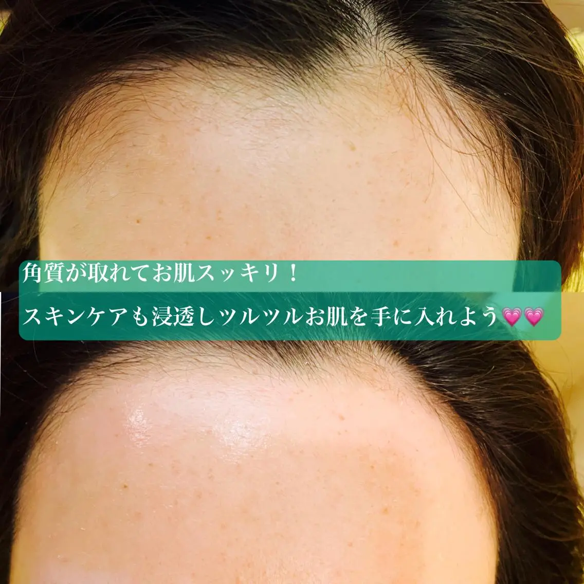 🌟フェイシャルワックス🌟おでこ、もみ上げ、鼻下の写真