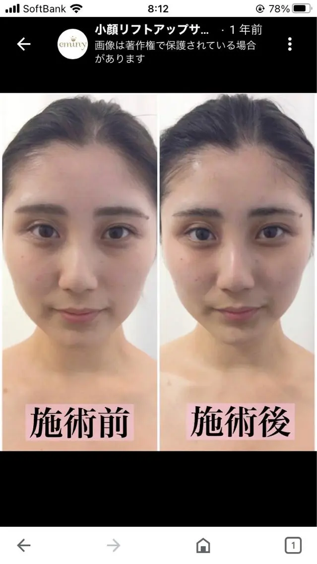 今だけキャンペーンクーポン‼️今月ご予約ご来店限定❗️即実感の小顔フェイシャル❗️40分5,000円の写真