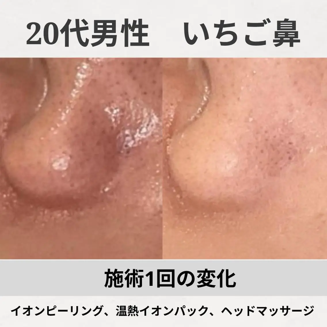 エステ リラク ニキビ跡改善専門🔥 医療にはできない改善のエステ・リラクイメージ