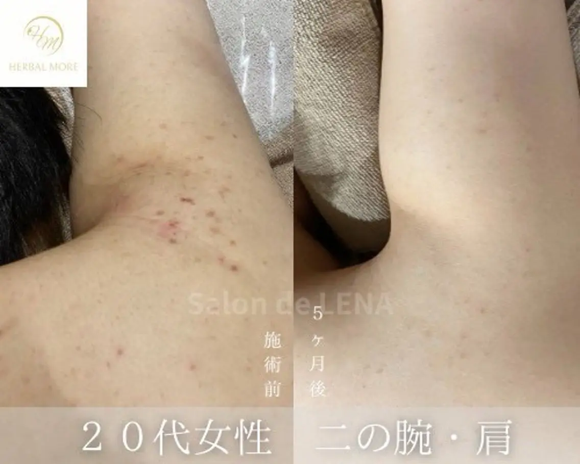 エステ ハーブピーリング専門 サロンドレナ平岡のエステ・リラクイメージ
