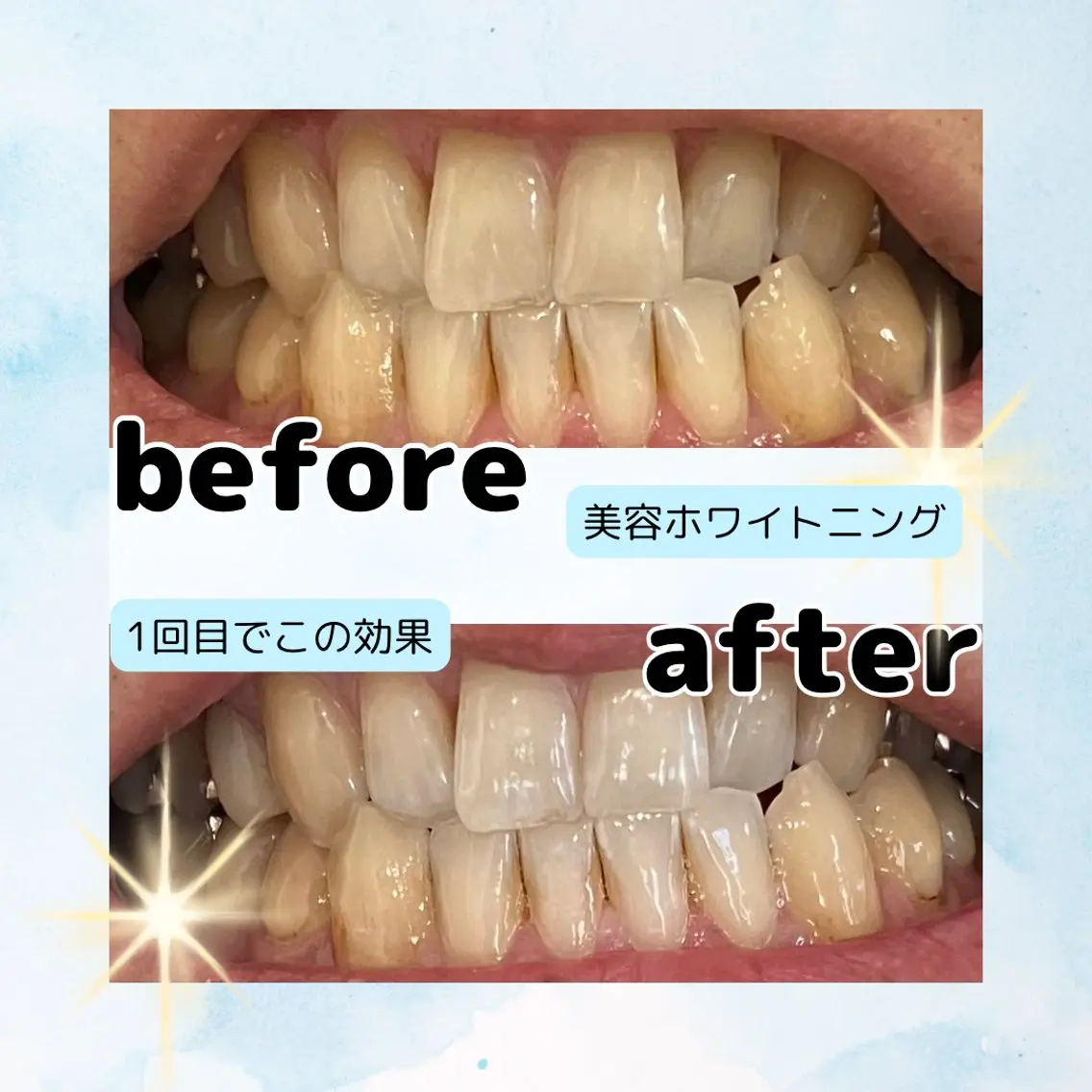 ミニモ限定!6/28まで限定!美容ホワイトニング8分2照射→8分3照射1680円🦷✨の写真