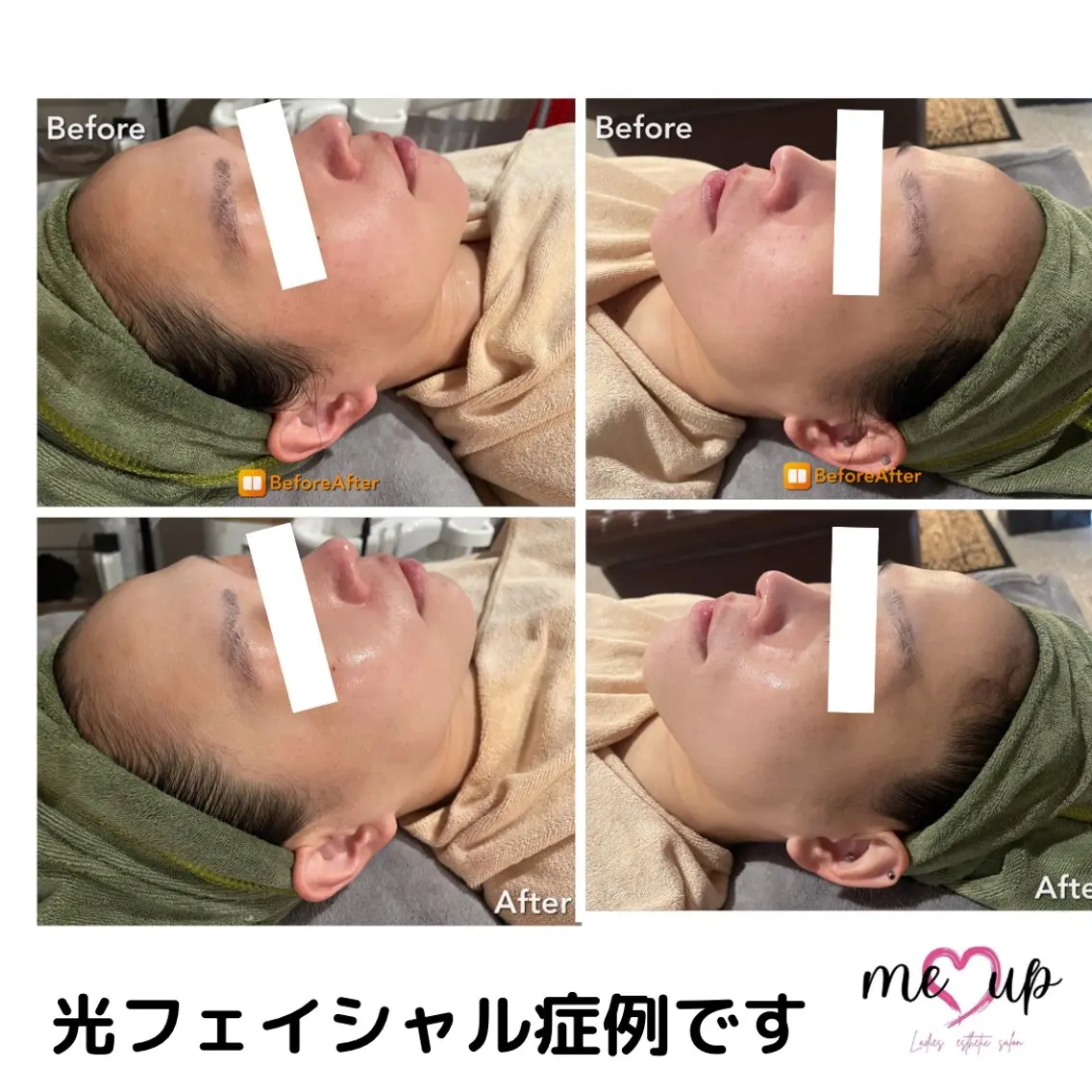 エステ Meupニキビ専門店 背中/ハーブ/肌管理のその他イメージ