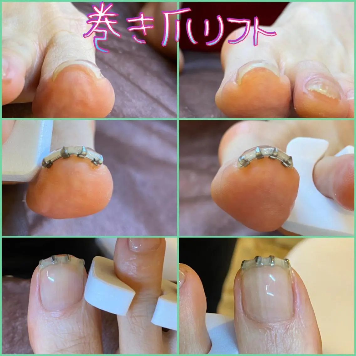 ネイル ジェルネイル ♢ME2ROOM♢ #巻き爪#リラクのネイルデザイン