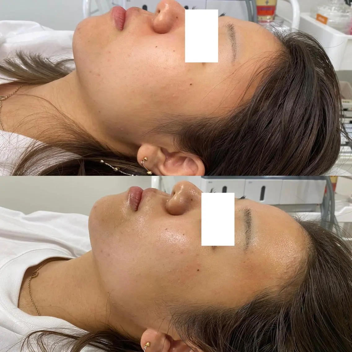 「3回まで利用可能！」リフトアップ・肌質改善・SPの写真