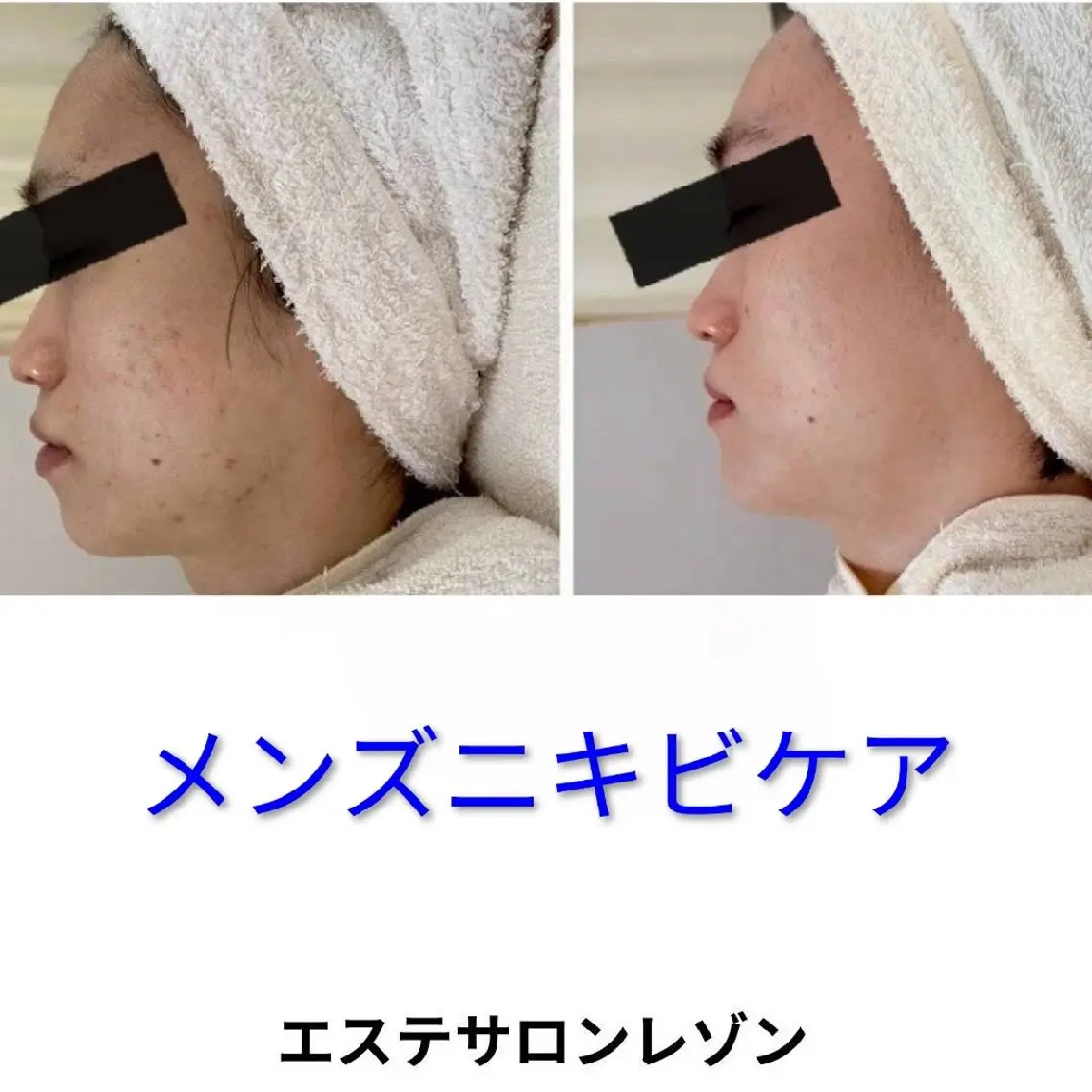 メンズ エステ 京橋〈ニキビ・ニキビ 跡ケア〉レゾン浅川のエステ・リラクイメージ