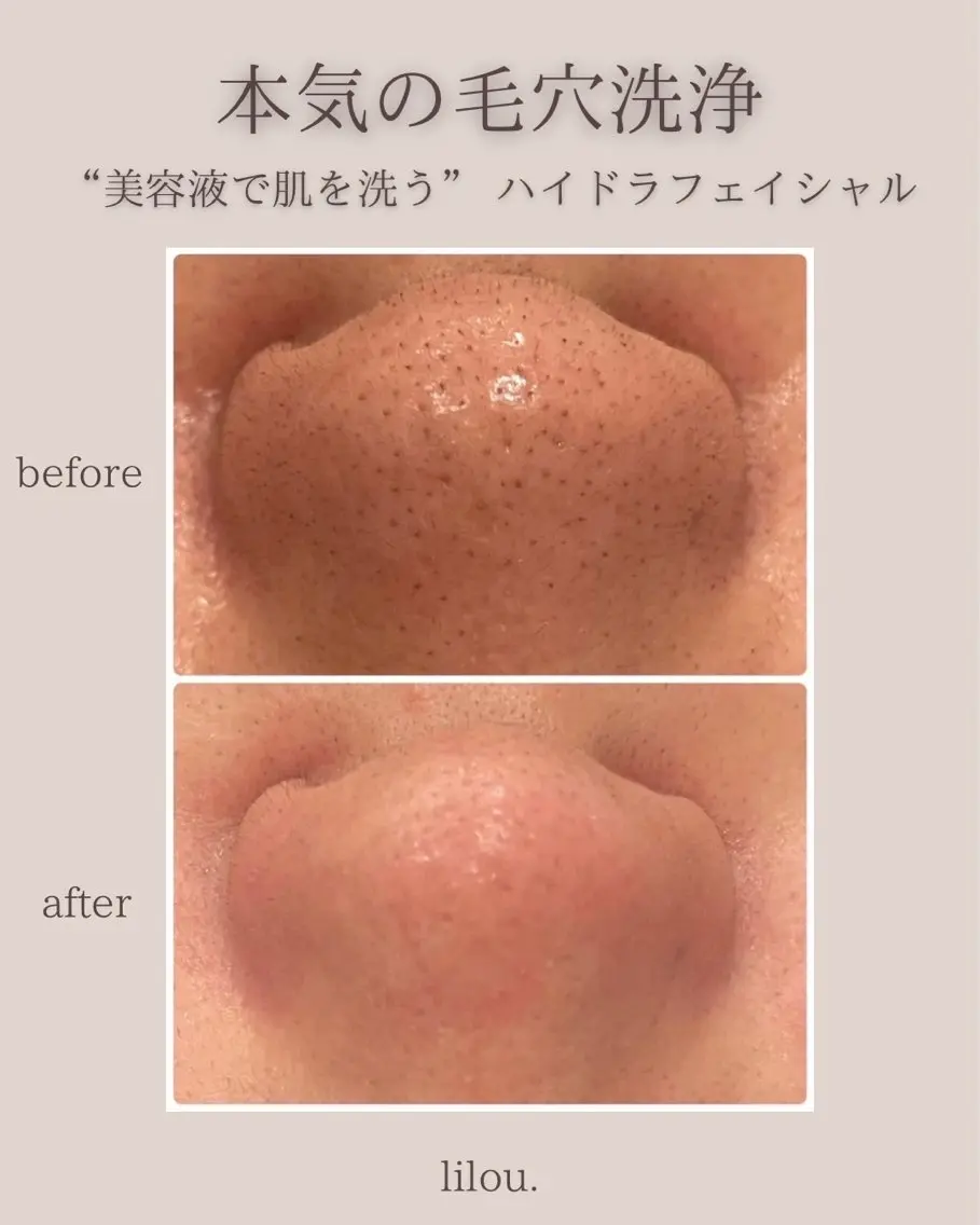 ⚠️人数限定⚠️人気no.2‼️【毛穴洗浄】✨美容液で洗う肌✨ハイドラ毛穴洗浄合わせの写真