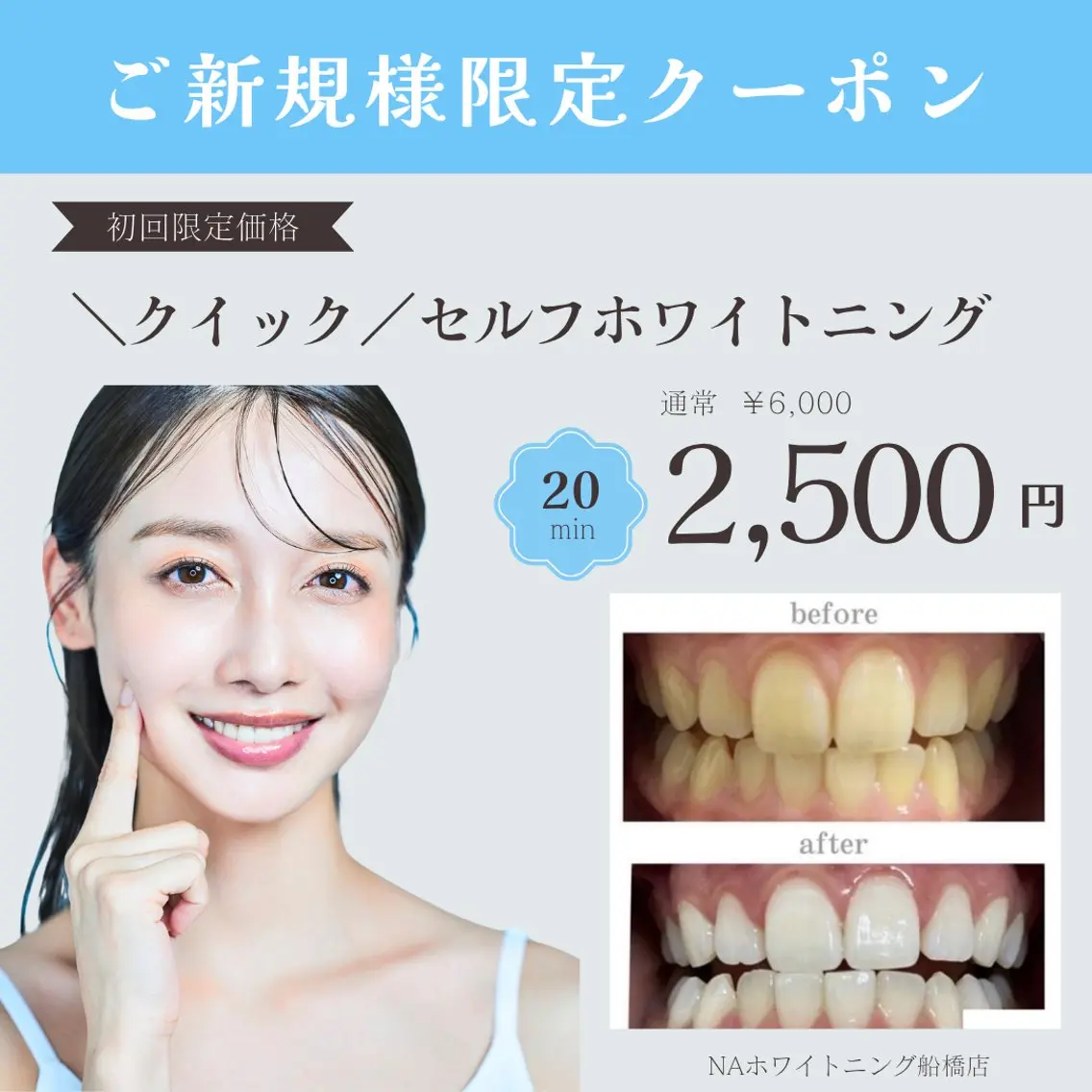 【今月限定】Google口コミで⭐︎クイック⭐︎セルフホワイトニング¥6,000→¥2500（照射時間20分)の写真