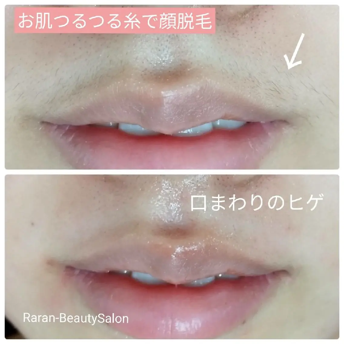続けやすい🎵【お肌つるつる糸で顔脱毛* 美肌再生コース】うぶ毛✨ひげ✨ボサボサ眉毛✨化粧ノリアップ‼️の写真