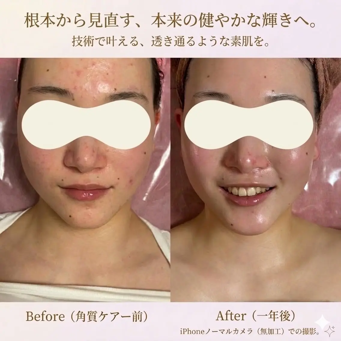 【剥離なし✨角質ケア】ツヤ肌バクテリウムピール＋デコルテケア付♡うる肌＆首元スッキリ✨の写真