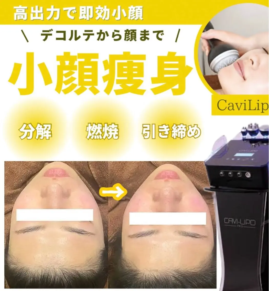 【小顔エステ】強カリフトアップ‼️25kHzキャビx高出力ラジオ波🔥デコルテ首肩も施術の写真