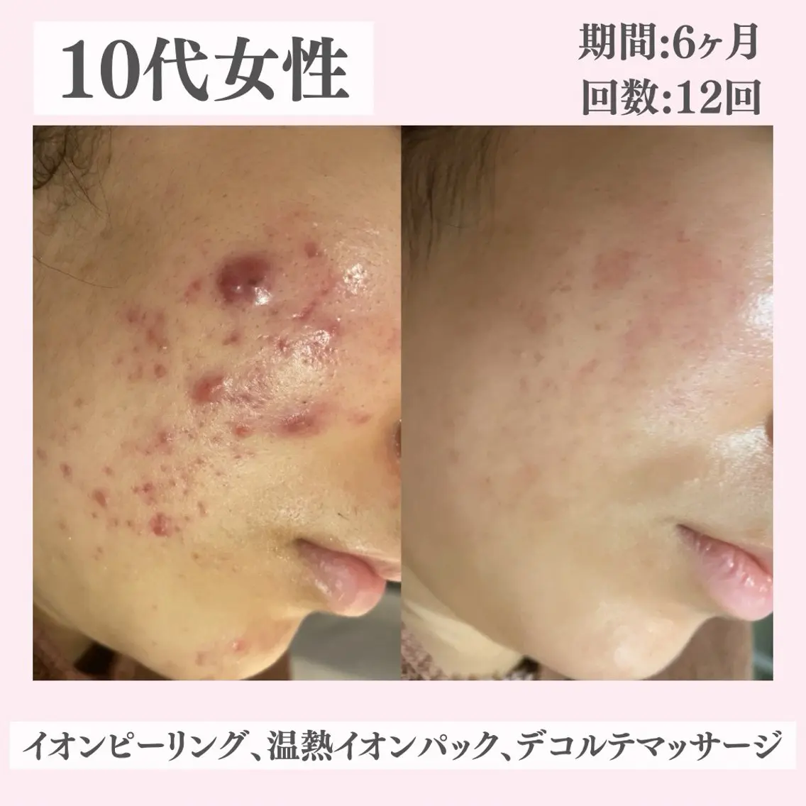 エステ リラク ニキビ・肌質改善専門 ♡人生が変わるサロンのエステ・リラクイメージ