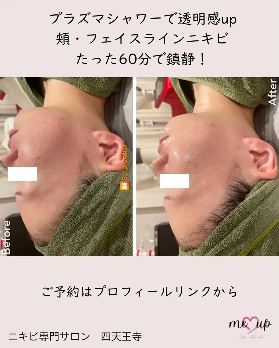 エステ Meupニキビ専門店 背中/ハーブ/肌管理のその他イメージ