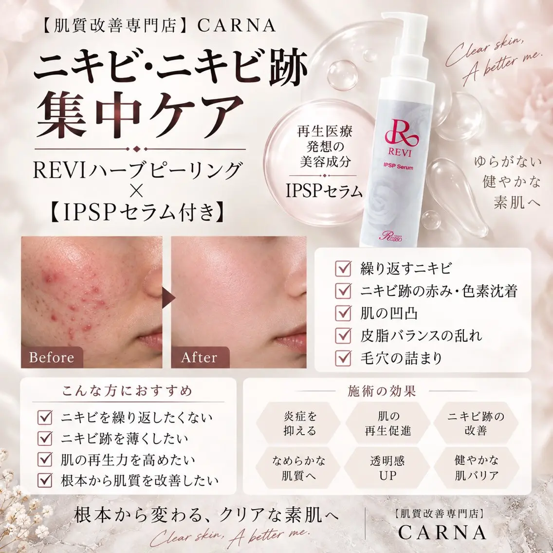 【ニキビ・ニキビ跡ケア】お試しREVIハーブピーリング☆陶肌パウダー+IPSP幹細胞セラム入り🎁の写真