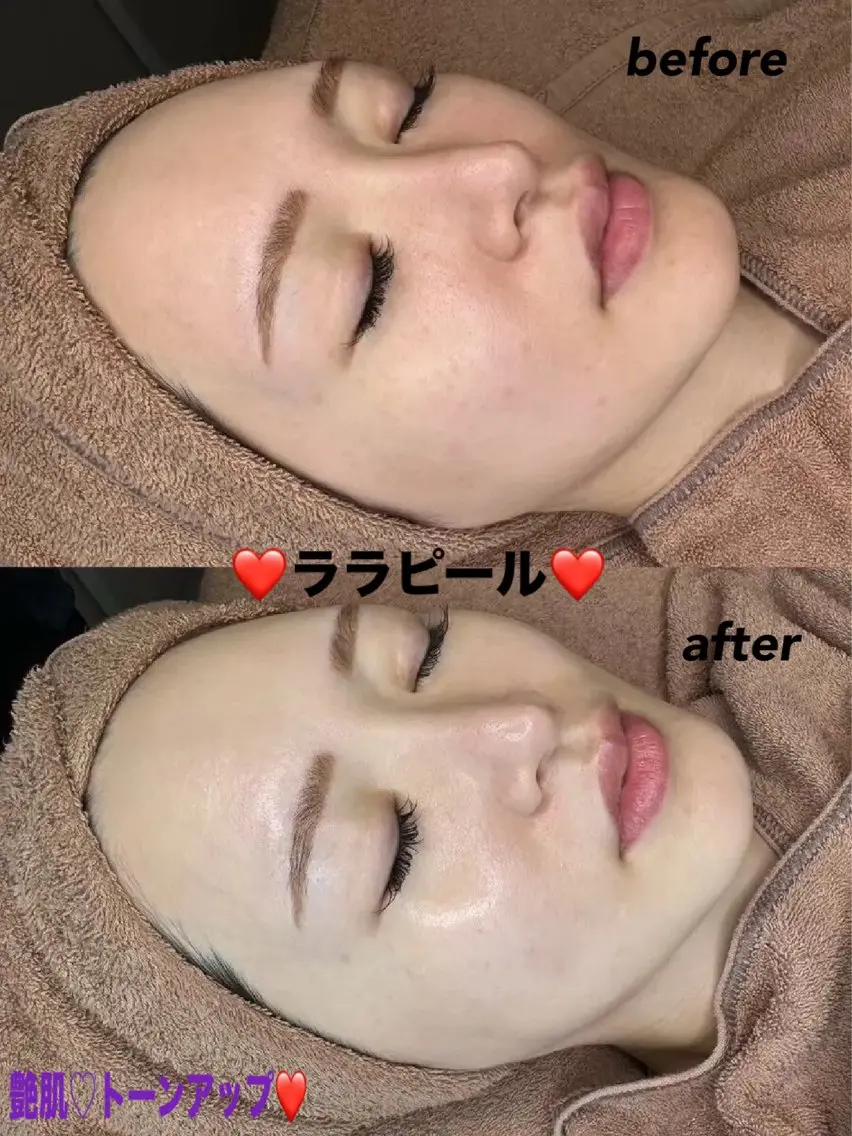 エステ ハーブピーリング専門 毛穴洗浄❤️眉waxのエステ・リラクイメージ