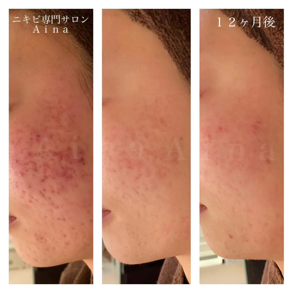 セミロング カラー パーマ ヘアアレンジ メンズ キッズ ネイル マツエク・マツパ 卒業式のヘアスタイル 卒業式 赤色 エステ リラク ニキビ跡専門サロン Ainaのエステ・リラクイメージ