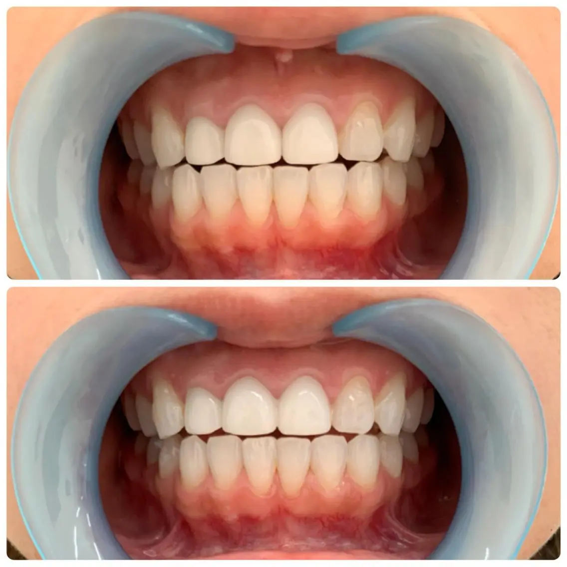 白さ実感✨回数券セルフホワイトニング🦷の写真