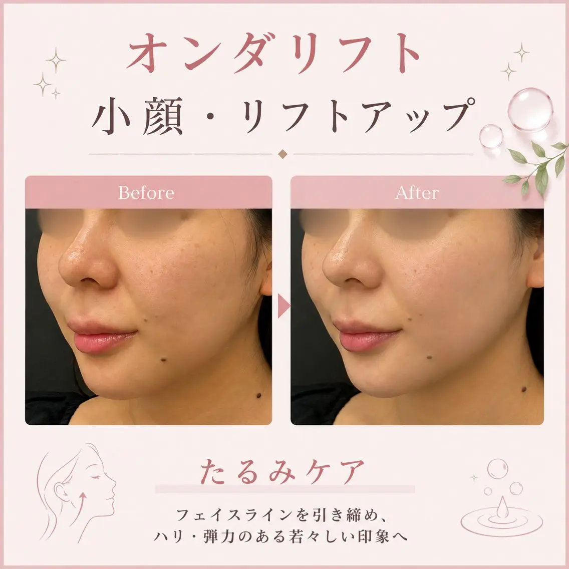 《小顔ケア✨》オンダリフト 【たるみ/二重あご/脂肪ケア/引き締め】の写真