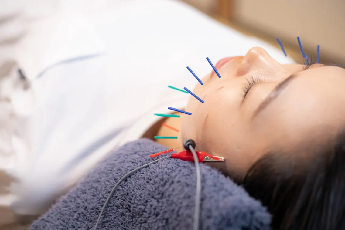 🥇人気No.1🥇気になる毛穴の開きにも！最先端電気美容鍼⚡️の写真