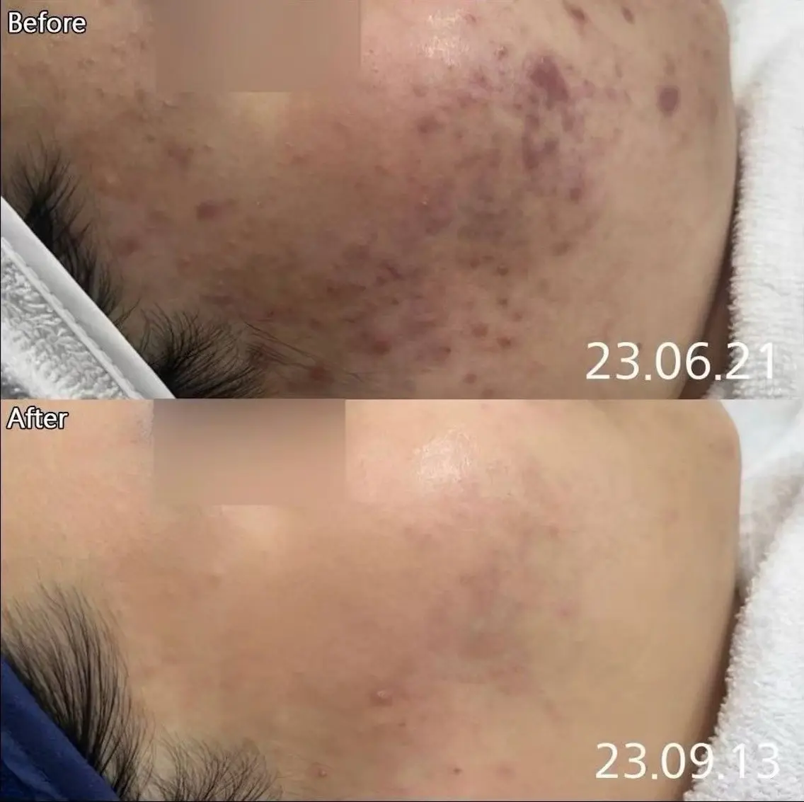 韓国美容をいち早く!針を使用しない肌荒れを防ぐケア※初回1回のみの写真