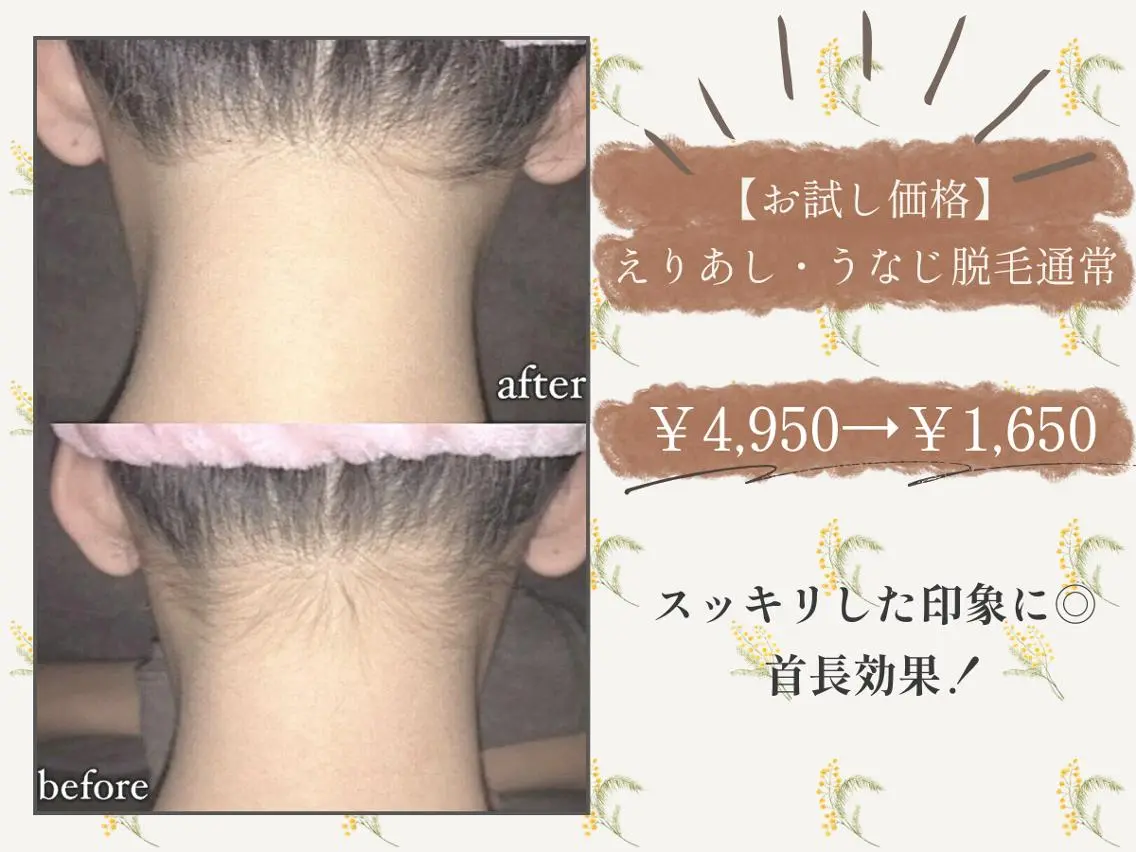 【お試し価格】えりあし・うなじ脱毛通常￥4,950→￥1,650の写真