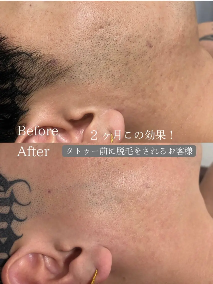 ✨1周年感謝祭クーポン✨期間限定【光脱毛】ワンパーツ(髭/脇/脚/腕)の写真