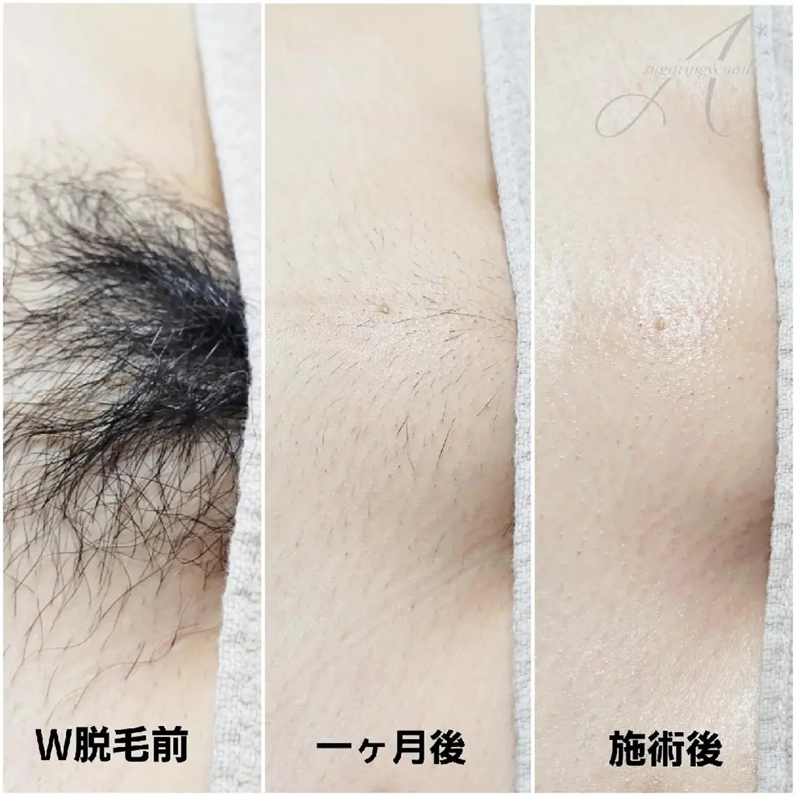 【1番人気🌟】VIOダブル脱毛🍋シュガーリング×最新光脱毛の写真
