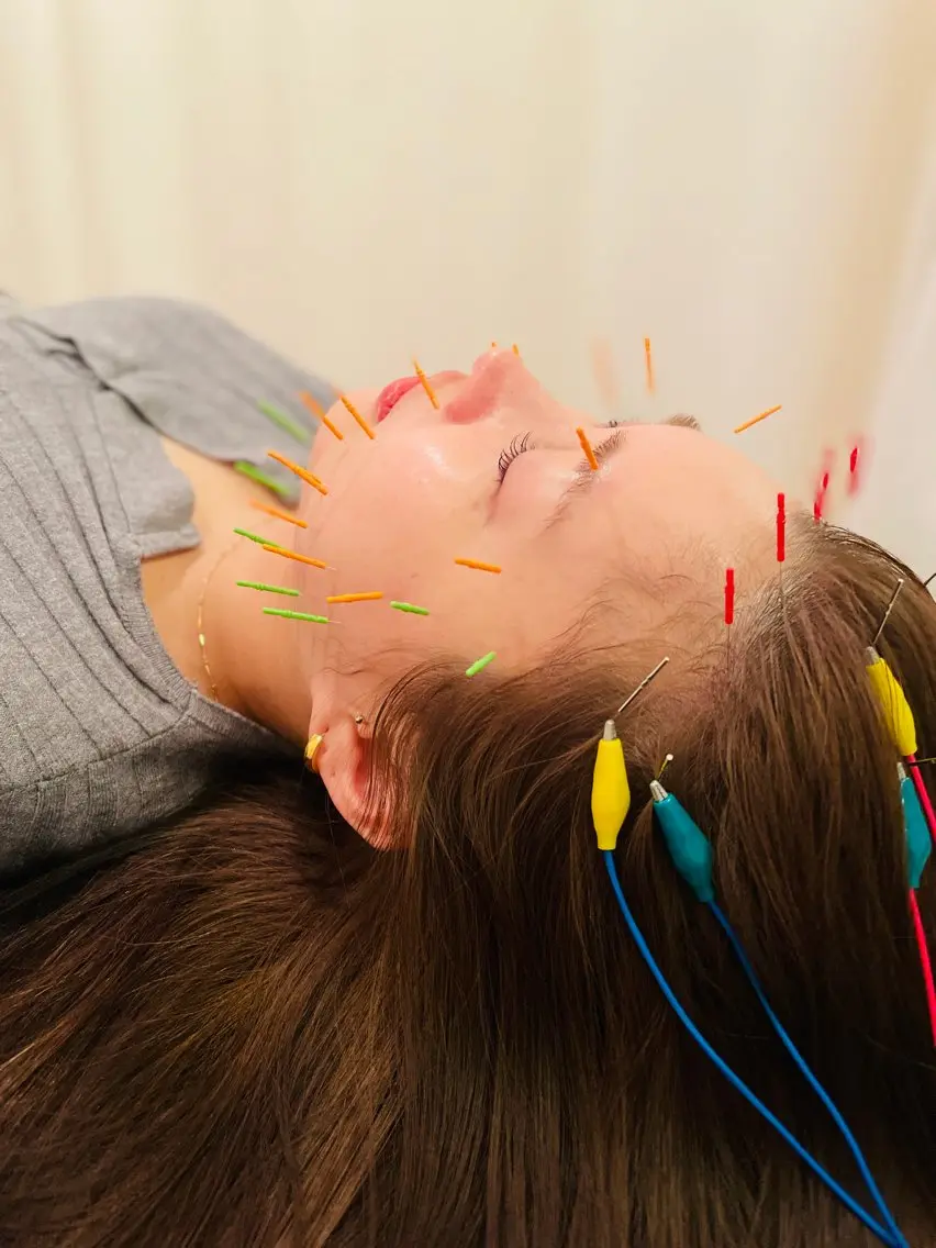 【40本使用】美容鍼(電気有⚡️)スタンダードコースの写真