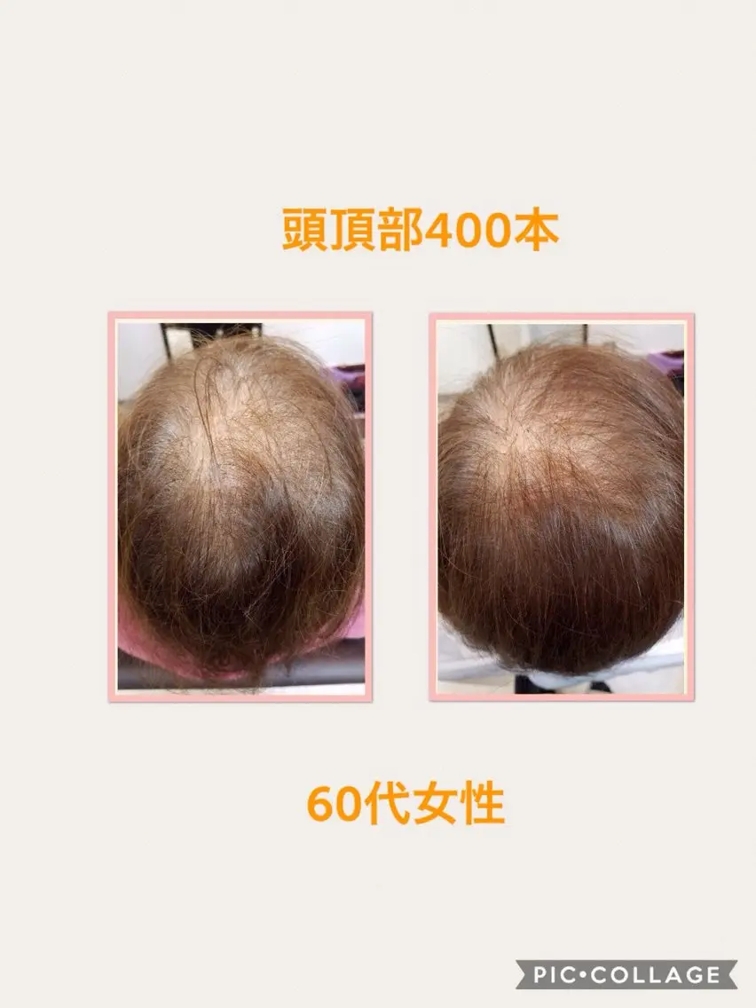 分け目・つむじ 自然増毛専門のヘアスタイル