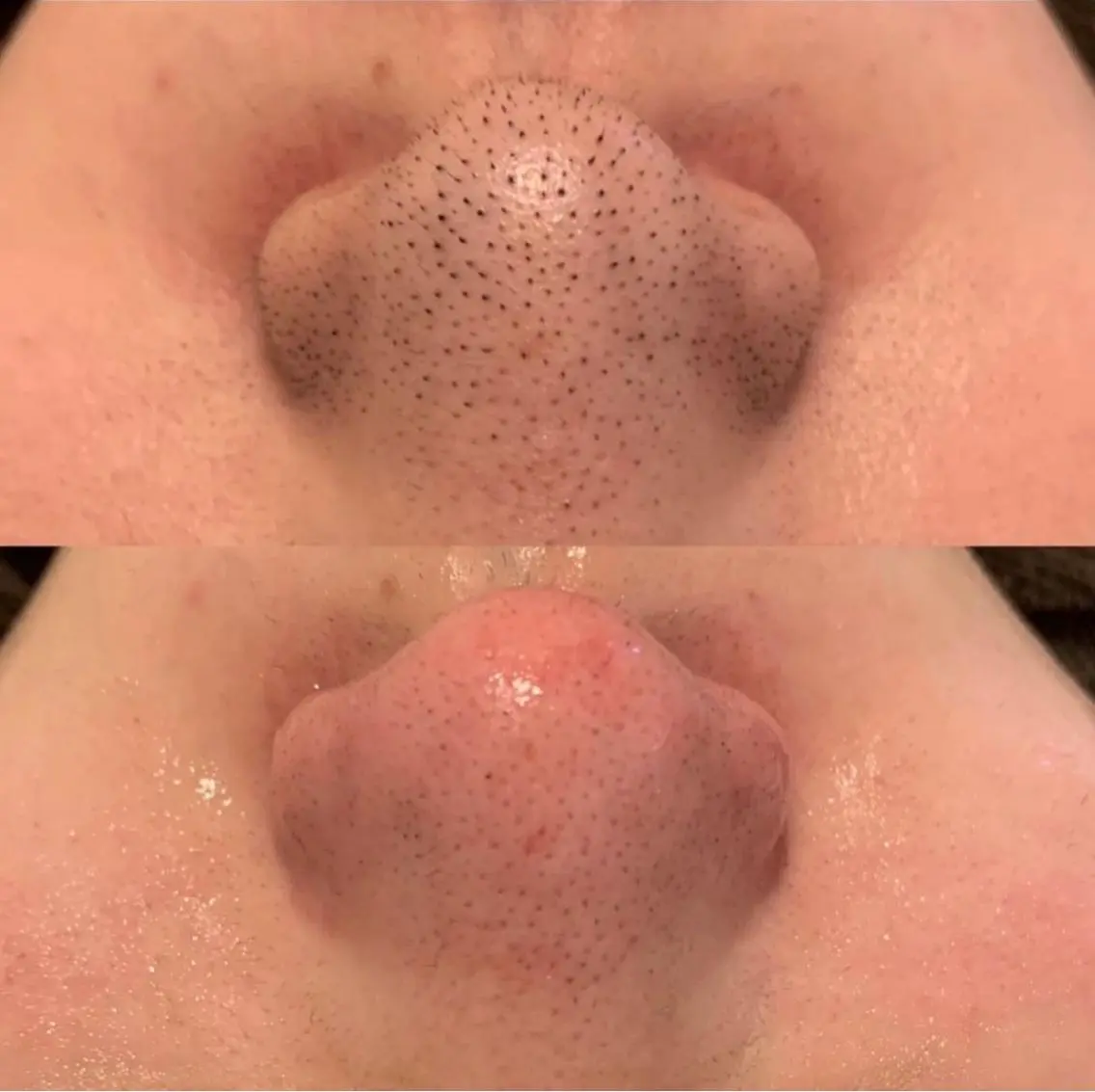 毛穴エクストラクション＋エレクトロクレンジング＋パック＋導入（デコルテマッサージ付）👃🏼の写真