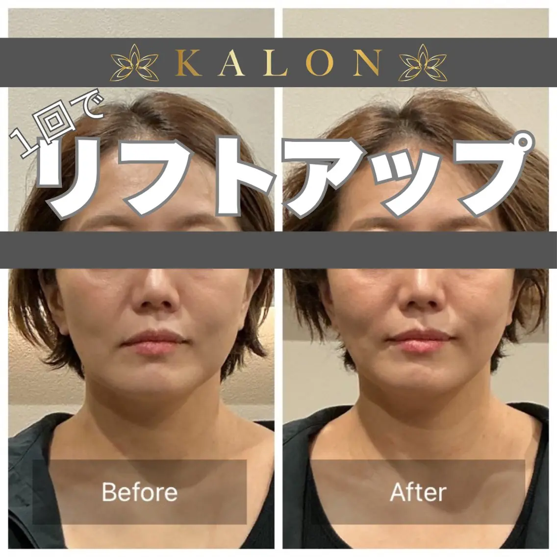 エステ リラク 美容鍼×整体 KALONのエステ・リラクイメージ