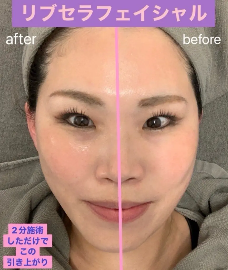 当店人気No. 1メニュー　整形級エステ　　　　　　　　　　　　　　　　✨リブセラフェイシャル✨の写真