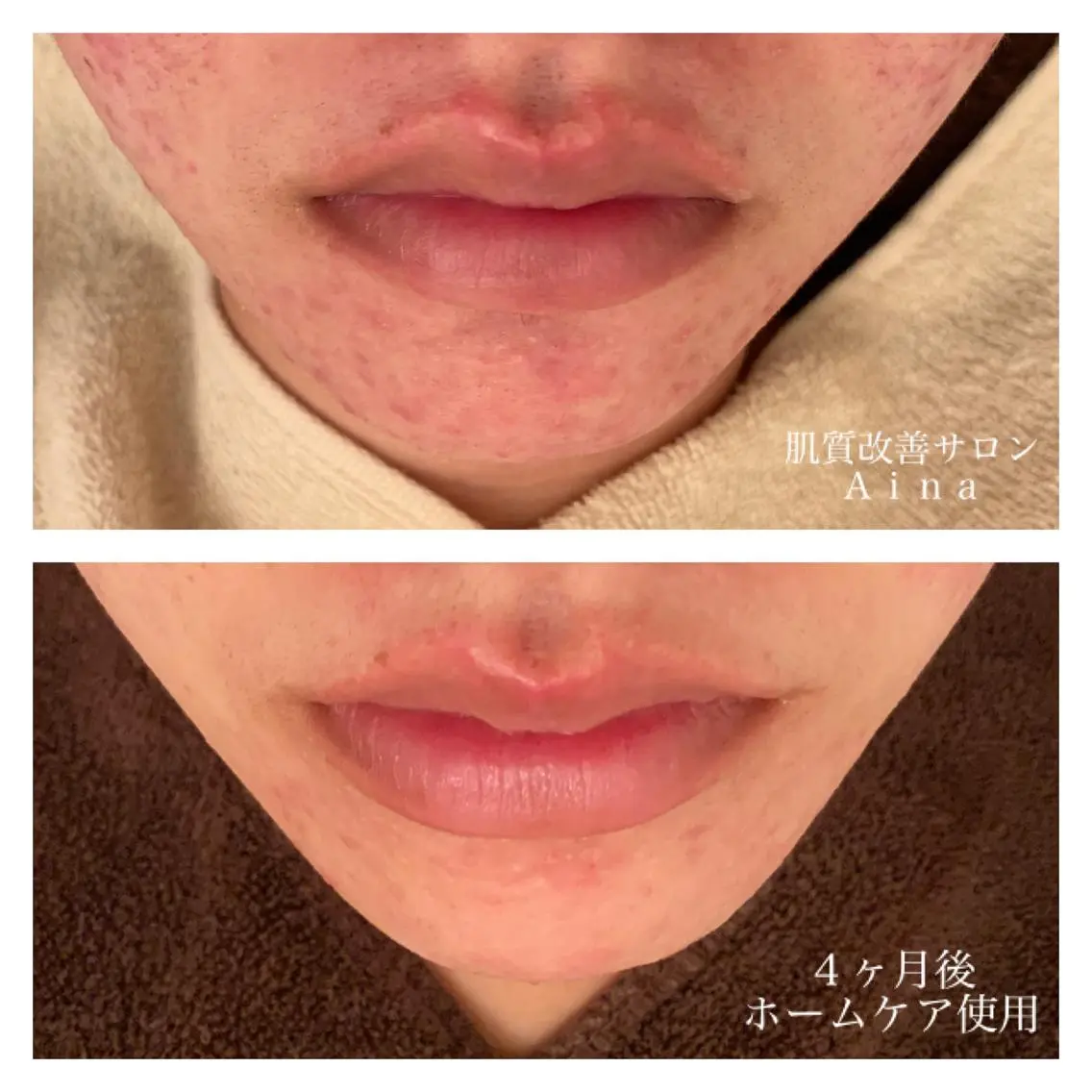 ミディアム カラー パーマ ヘアアレンジ メンズ キッズ ネイル マツエク・マツパ 赤色 ニキビ跡専門サロン Ainaのエステ・リラクイメージ
