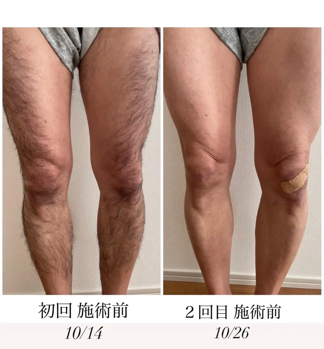 【MEN'S 足脱毛】腿から足の指毛までツルンツルン🤭の写真